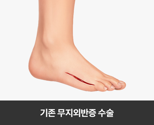기존 무지외반증 수술