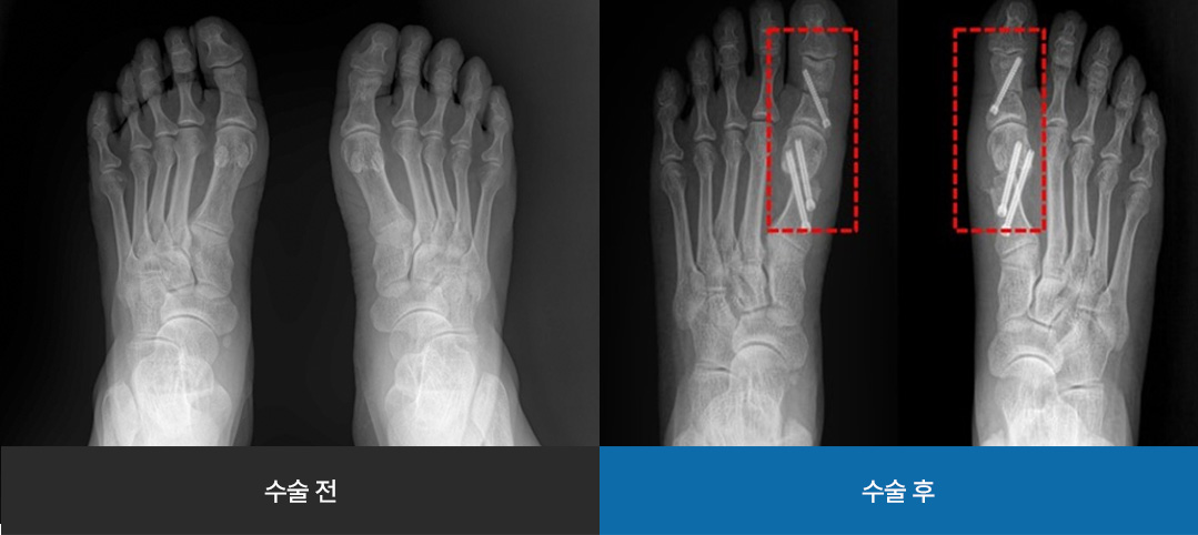 수술 전 / 수술 후