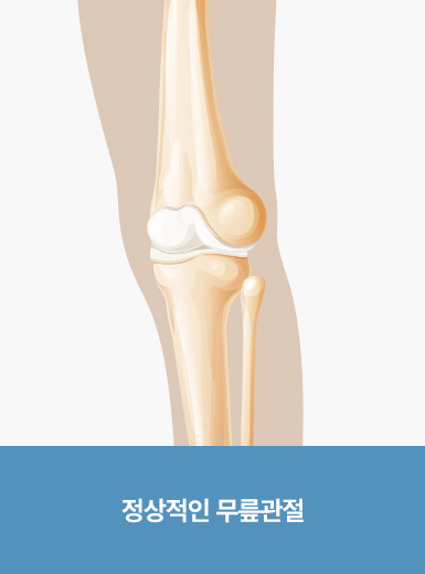 정상적인 무릎관절