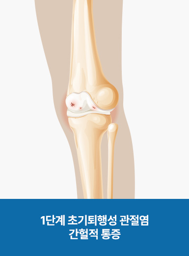 1단계 초기퇴행성 관절염 간헐적 통증