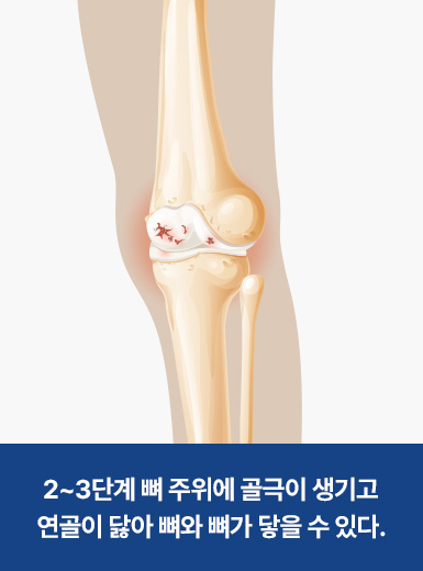 2~3단계 뼈 주위에 골극이 생기고 연골이 닳아 뼈와 뼈가 닿을 수 있다.