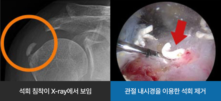 석회 침착이 X-ray에서 보임 / 관절 내시경을 이용한 석회 제거